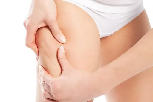 celulitis celulitis