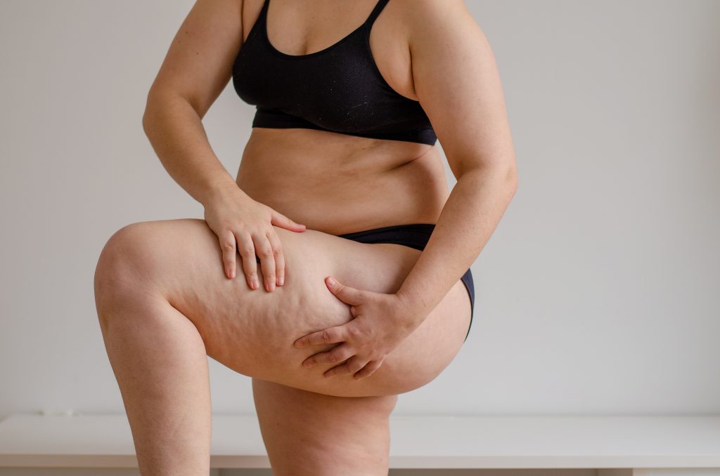 celulitis