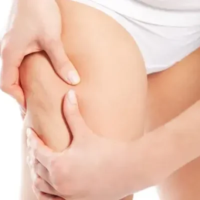 celulitis